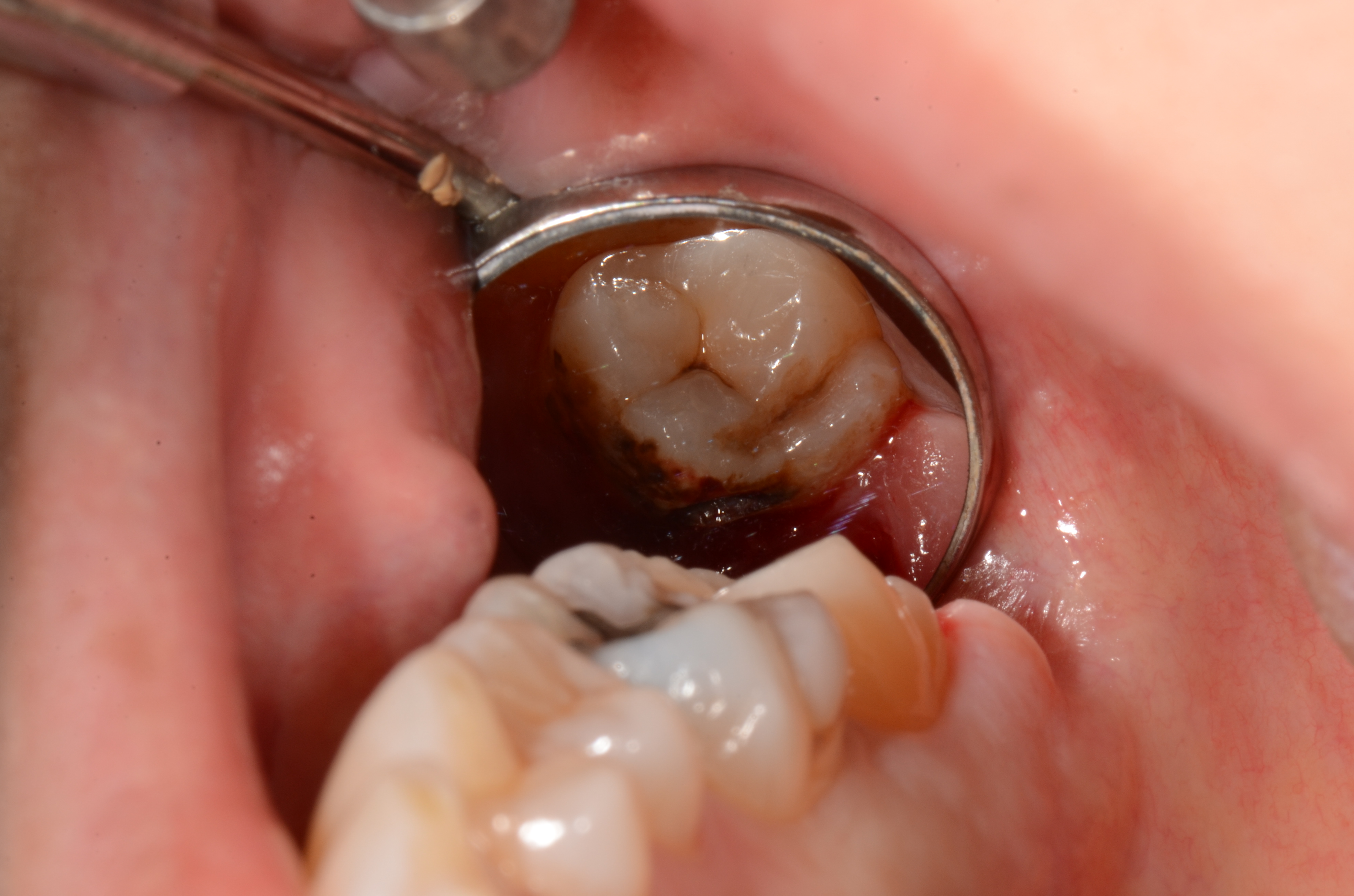 虫歯 の 治療