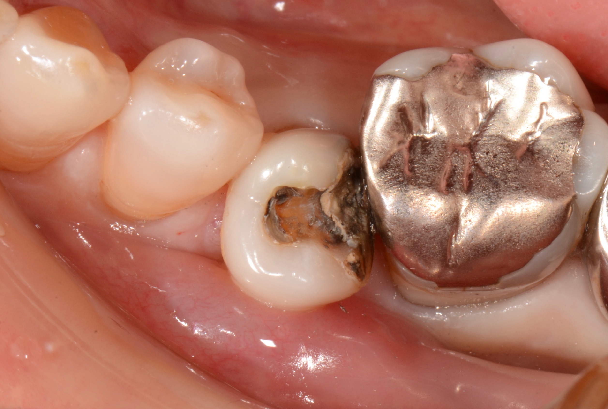 歯 が 欠け た 虫歯