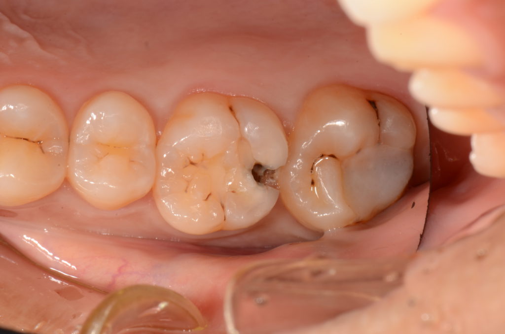 虫歯 穴 が 空い た