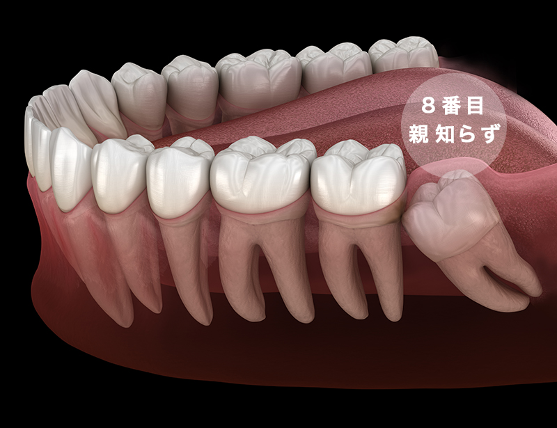 親知らず を 自分 で 抜く